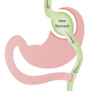 Gastricbypass schematic image