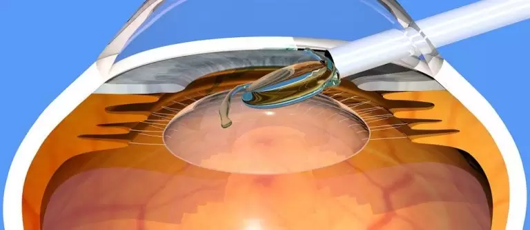 CLE and ICL Lens Implantation method with illustration