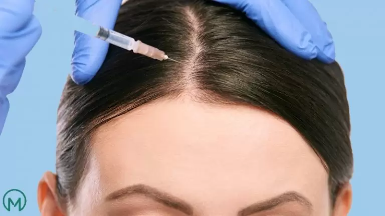 Mesotheraphy for Hair title image