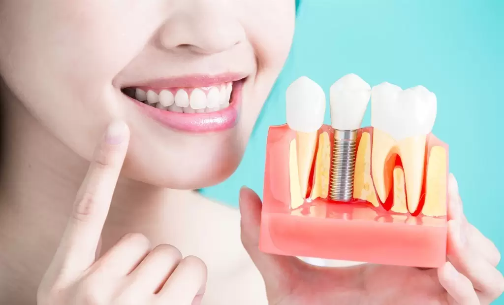 Dental implant is a surgical procedure that is consisted of a metal post and crown placed on it