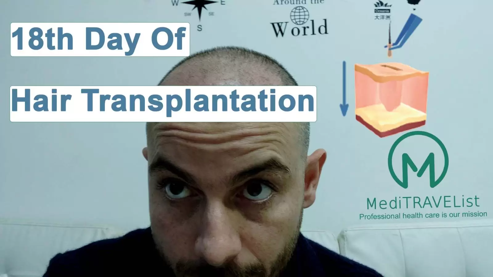 18th Day of Hairtransplantation video cover image