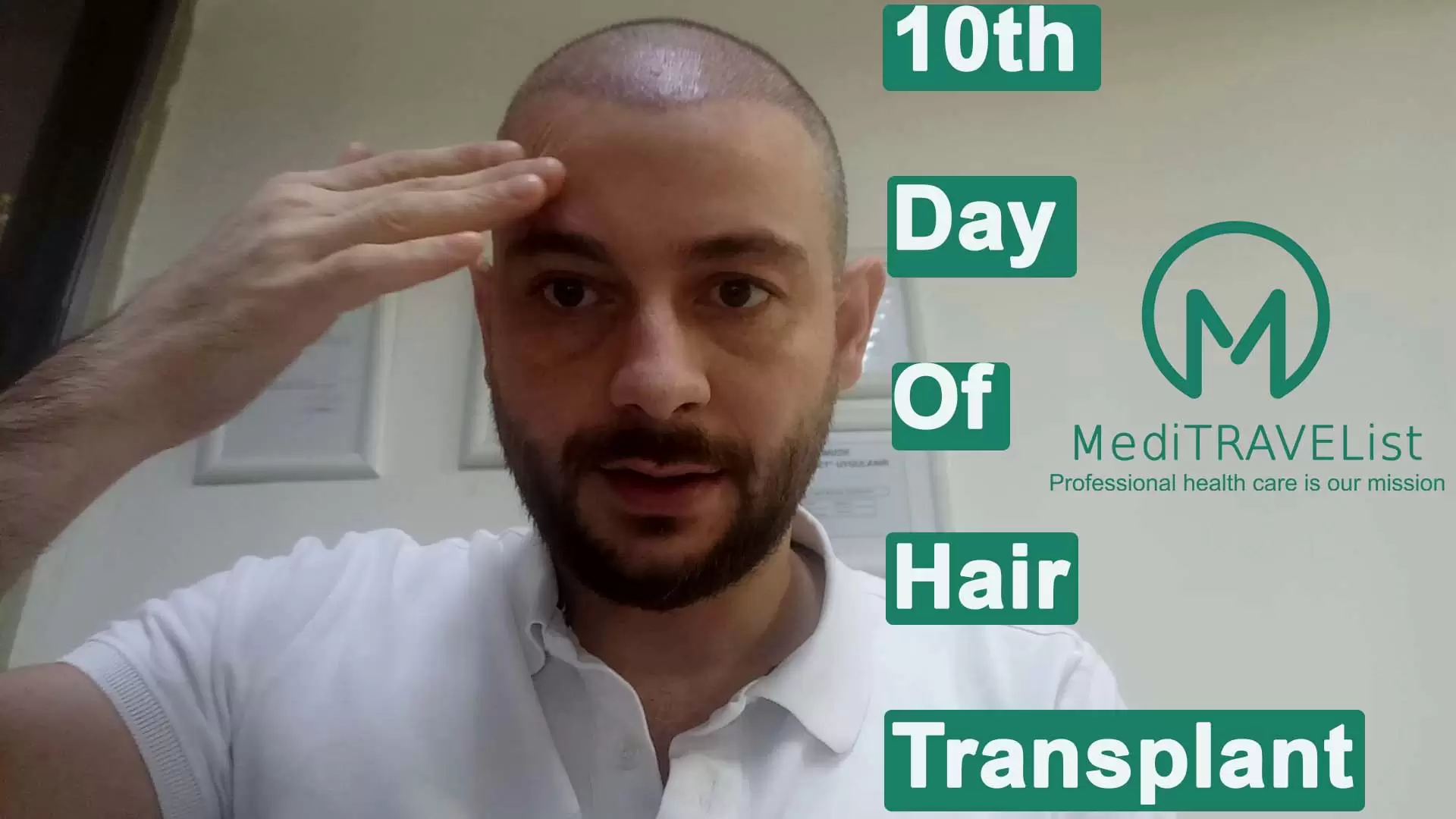 10th Day of Hairtransplantation video cover image