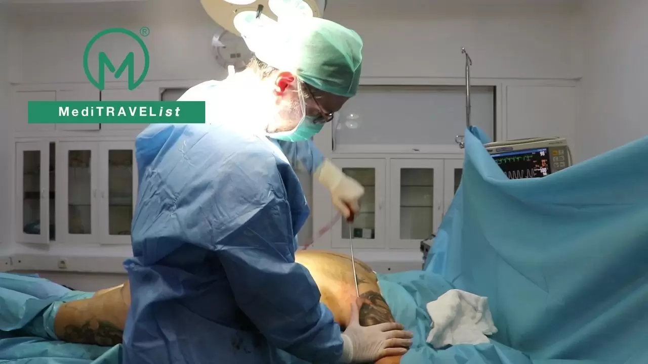 Thigh Lift and Liposuction Surgery