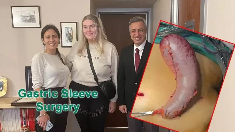 GASTRIC SLEEVE SURGERY VIDEO